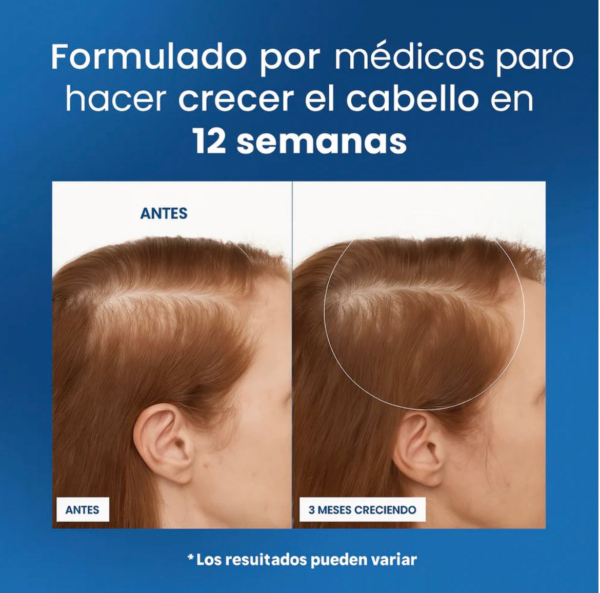 Roll-On de Crecimiento Capilar™